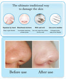 Removedor de Cravos Elétrico 3 Níveis – Limpeza Facial Profunda & Rejuvenescimento